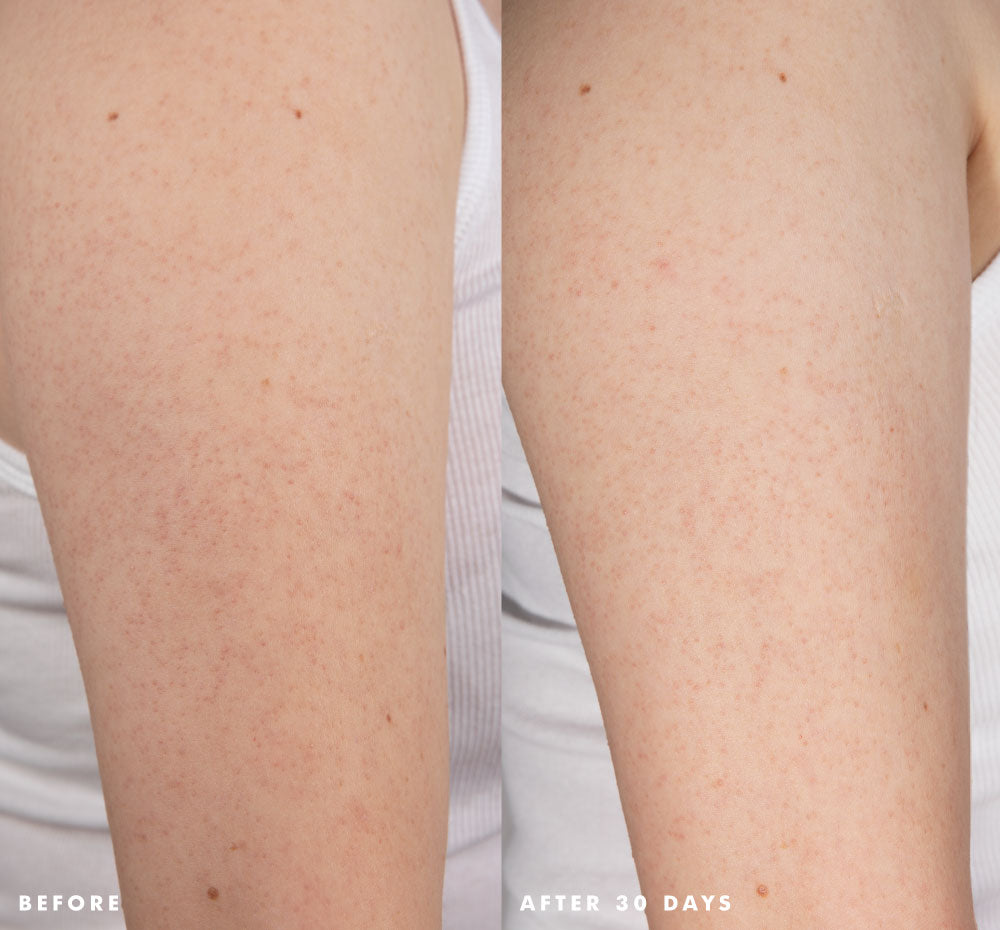 An arm before and after using FarmHouse Fresh Smooth Reveal Resurfacing Silky Serum, showing significant visible difference and improvement of KP bumps.