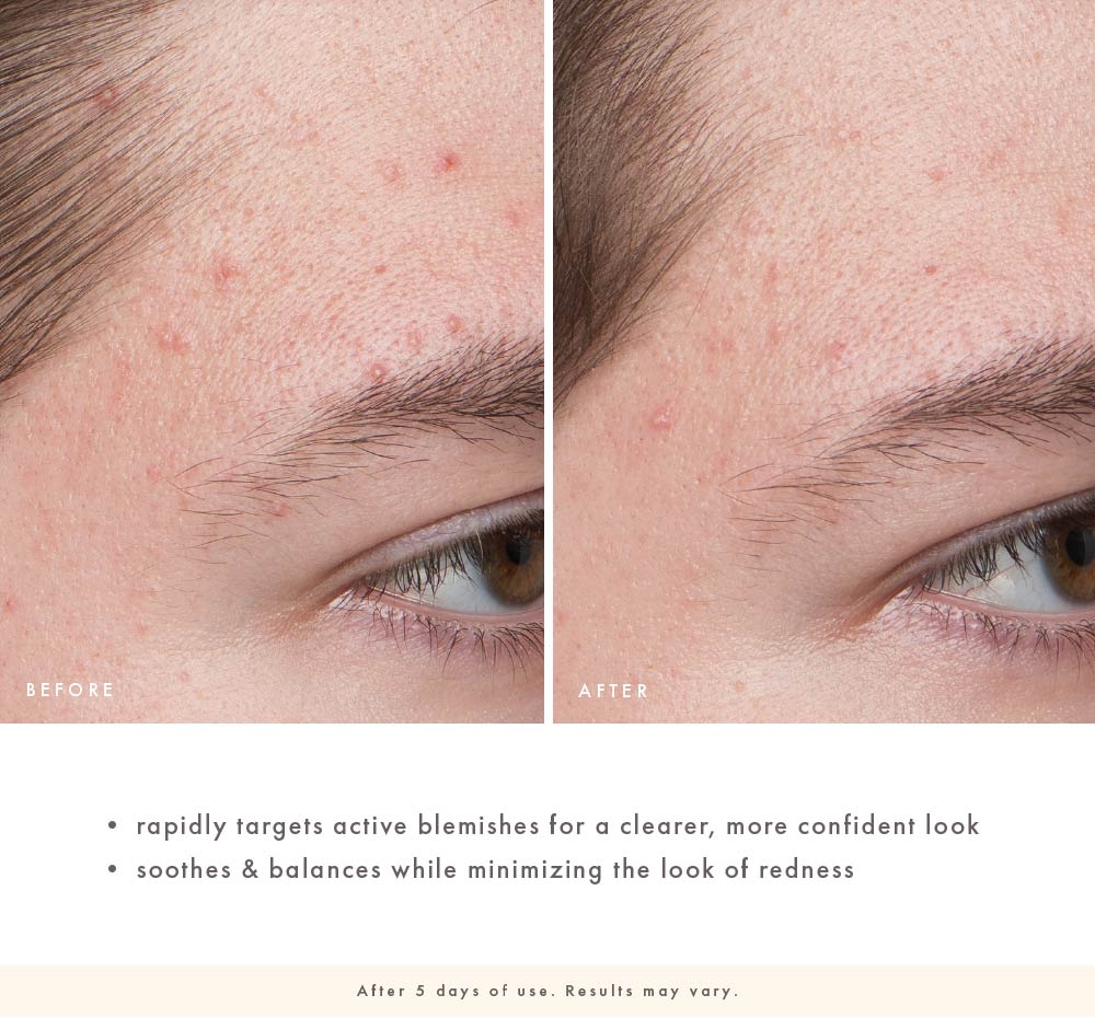 Before-and-after face close-up showing fewer visible blemishes and clearer-looking skin after 6 months of Comeback Clear use