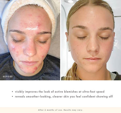 Before-and-after face close-up showing fewer visible blemishes and clearer-looking skin after 6 months of Comeback Clear use