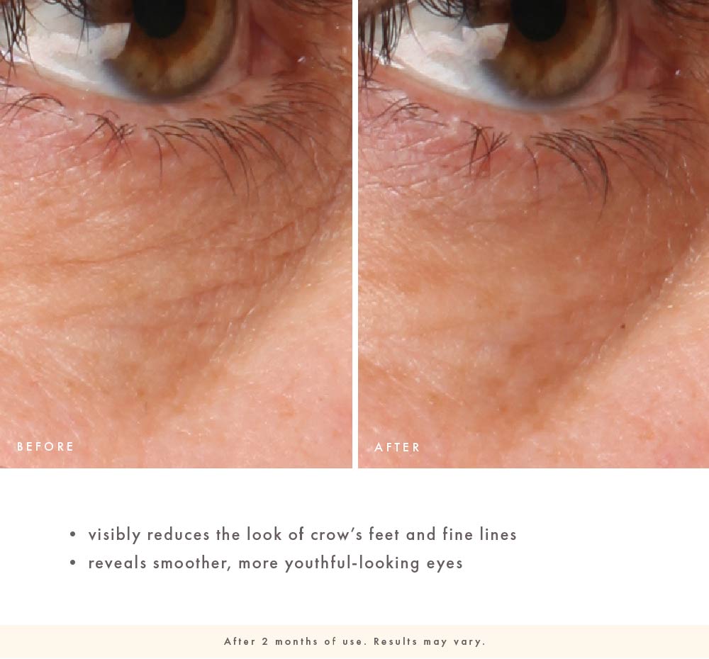 Before-and-after eye-area close-up showing reduced appearance of crow’s feet and fine lines after 2 months of Crow Catcher use