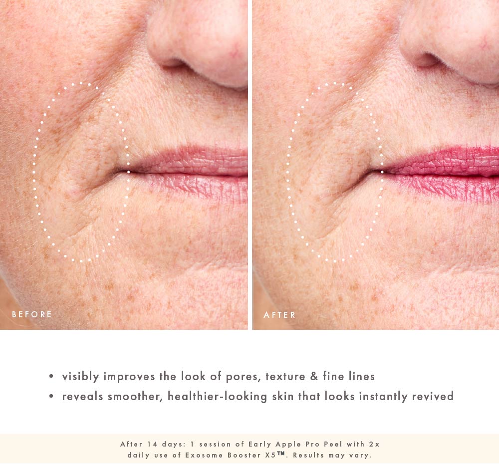 Before and after comparison of facial skin with text indicating product benefits from using FHF Exosome Booster X5