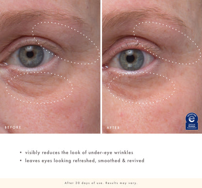 Before and after comparison of under-eye area with visible wrinkle reduction after using Eye'm Revived for 30 days.