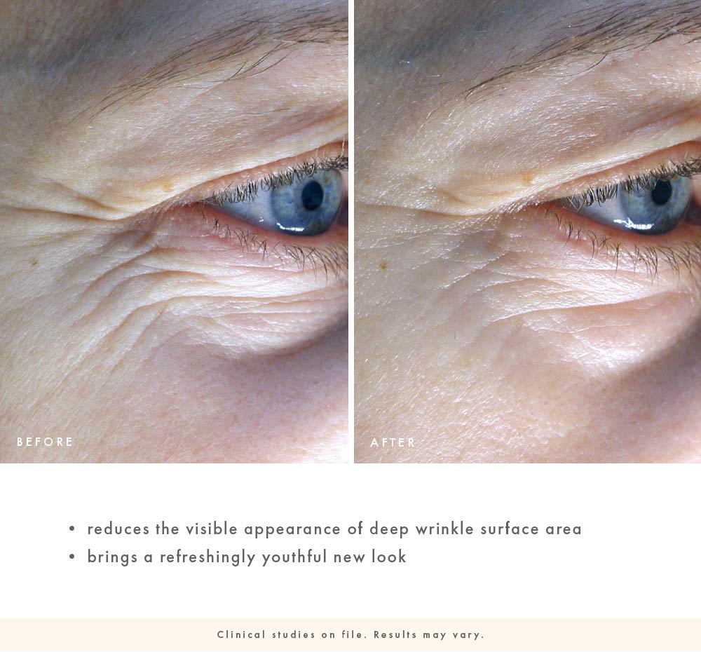 Clinical study of a before and after comparison of eye area with wrinkles, showing a youthful new look.