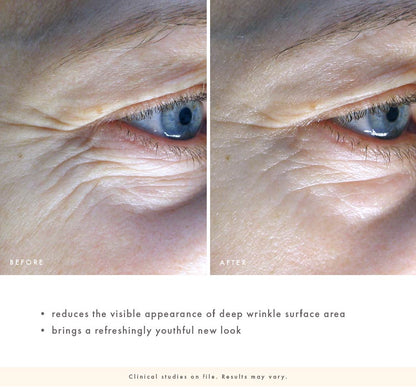 Clinical study of a before and after comparison of eye area with wrinkles, showing a youthful new look.