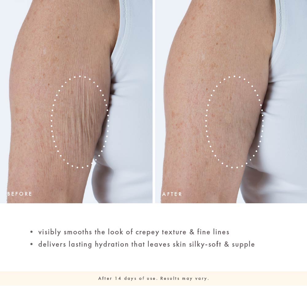 Before and after comparison of visibly smooth skin texture on a person's arm from benefits of Matrixyl.